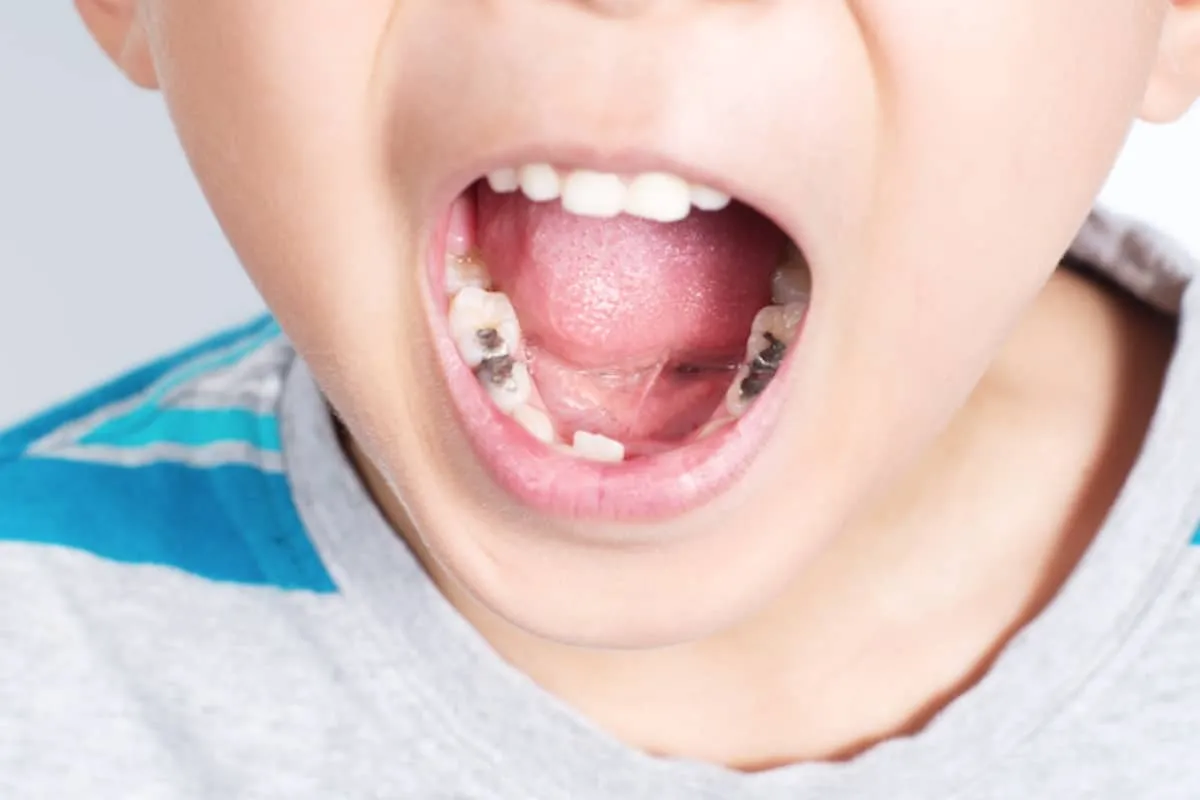 Prevent Cavities in Kids